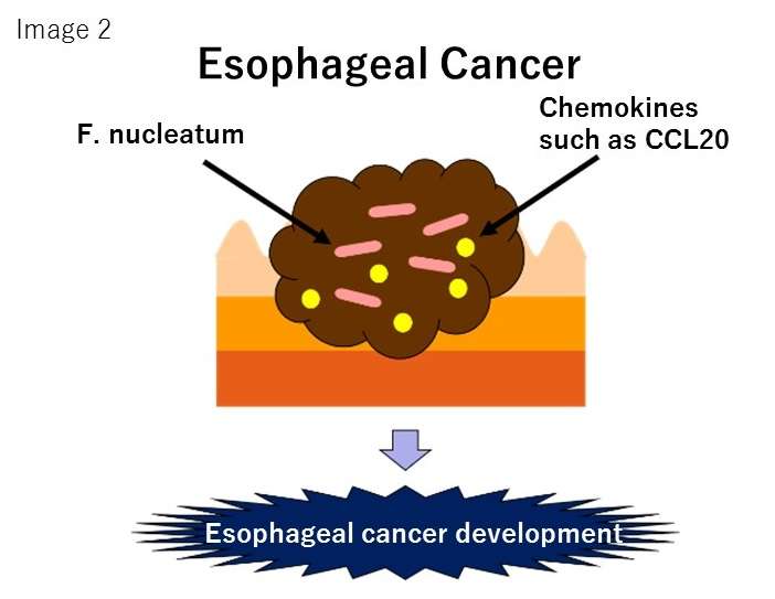 Oral bacterium related esophageal cancer prognosis in Japanese patients