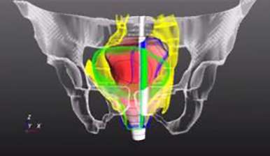 Pelvic nerves made visible: reduced risk in surgery