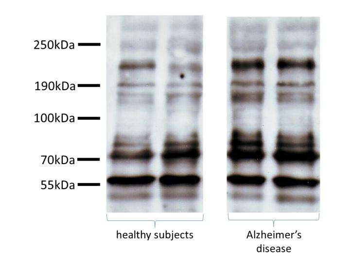 Promising discovery for a non-invasive early detection of Alzheimer's disease