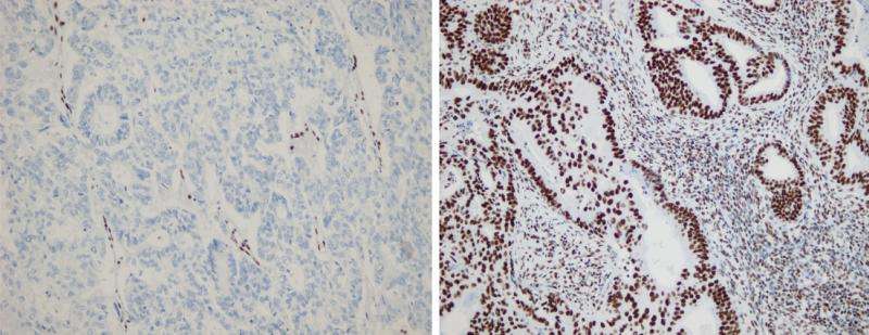 Study sheds light on role of mutations in metastasized cancer
