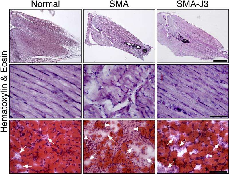 Study unveils new therapeutic target for spinal muscular atrophy