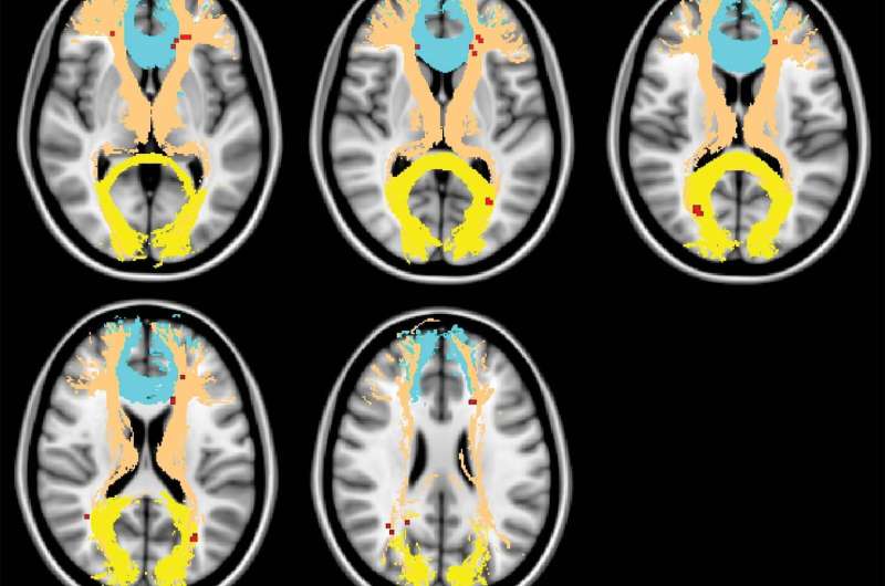 'Traffic jam' in brain linked to common cognitive disorder