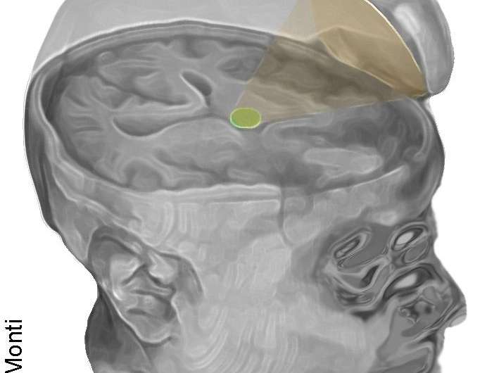 UCLA scientists use ultrasound to jump-start a man's brain after coma