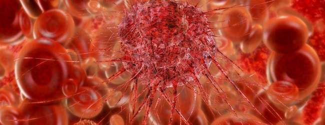 New insights into blood cancer that develops before birth