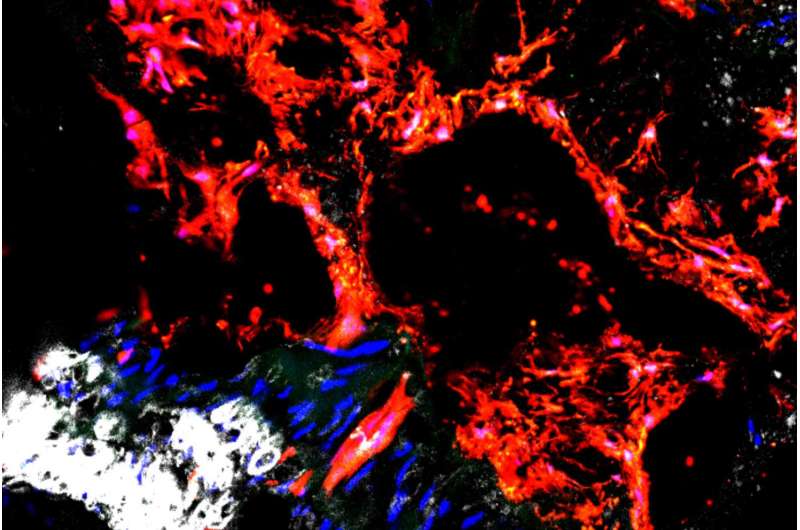 Scientists find culprit responsible for calcified blood vessels in kidney disease