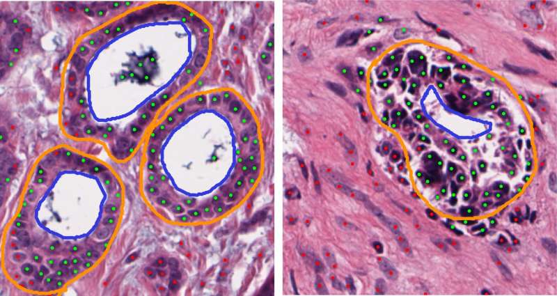 计算机化组织图像分析显示ER +乳腺癌的基础组织
