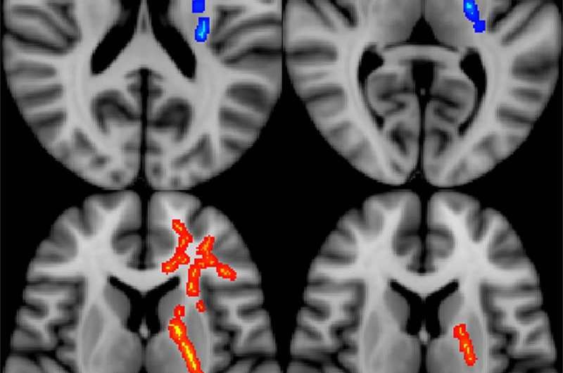 Imaging predicts long-term effects in veterans with brain injury