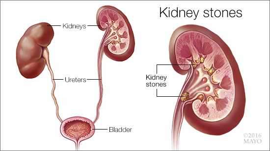 Research connects first-time kidney stone formers and chronic kidney disease