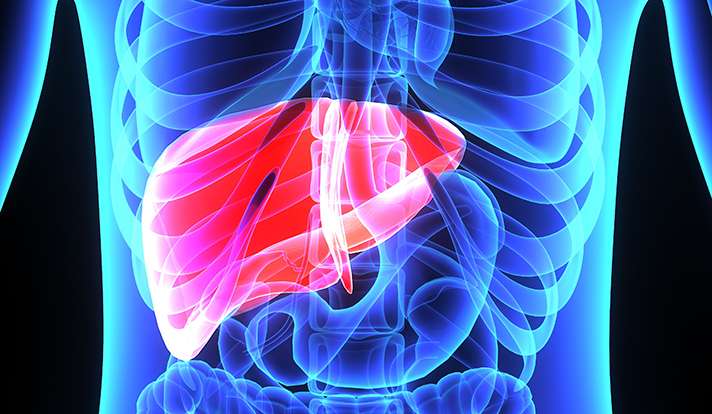 Research links fatty liver disease to type 2 diabetes