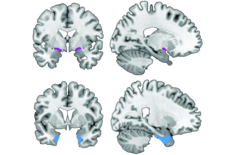 Study challenges model of Alzheimer's disease progression