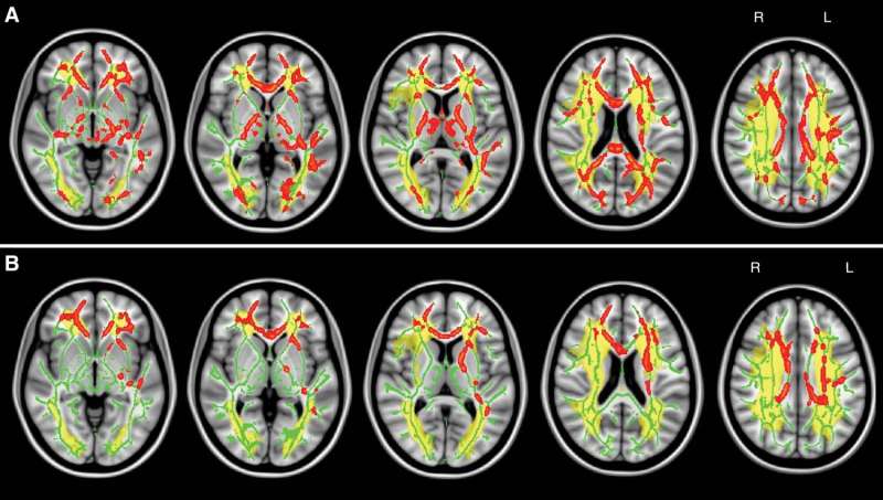 'Traffic jam' in brain linked to common cognitive disorder