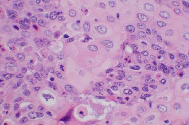 Researchers identify protein that could prevent tumor growth in cervical cancer