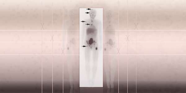 Scientists develop a new method to measure radiation dose in cancer patients