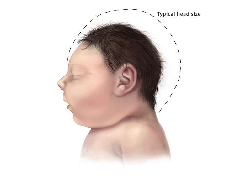 More evidence that zika causes microcephaly