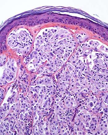 Scientists identify gene that regulates the growth of melanoma