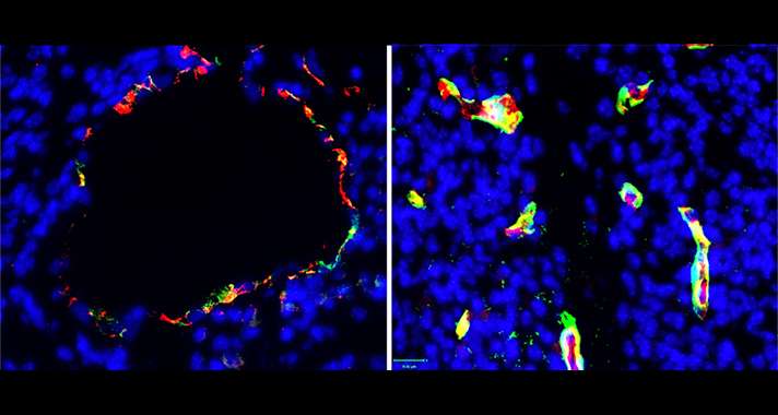 Study uncovers marker for a chronic brain disease