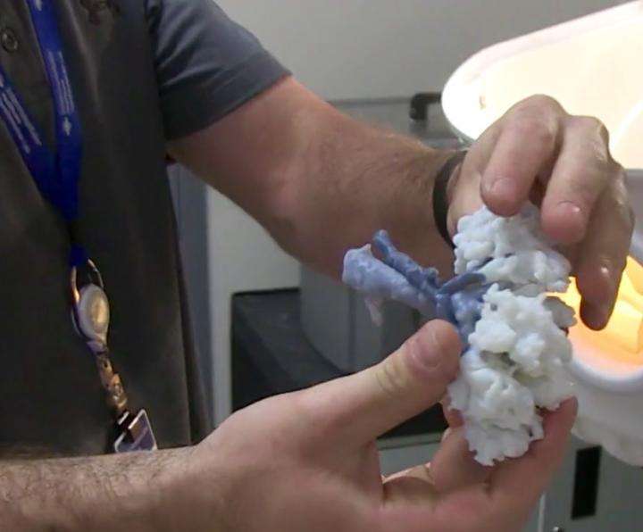 3-D-printed kidney helps doctors save woman's organ during complicated tumor removal