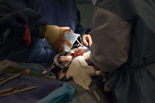 Organ transplants have come a long way but hurdles remain