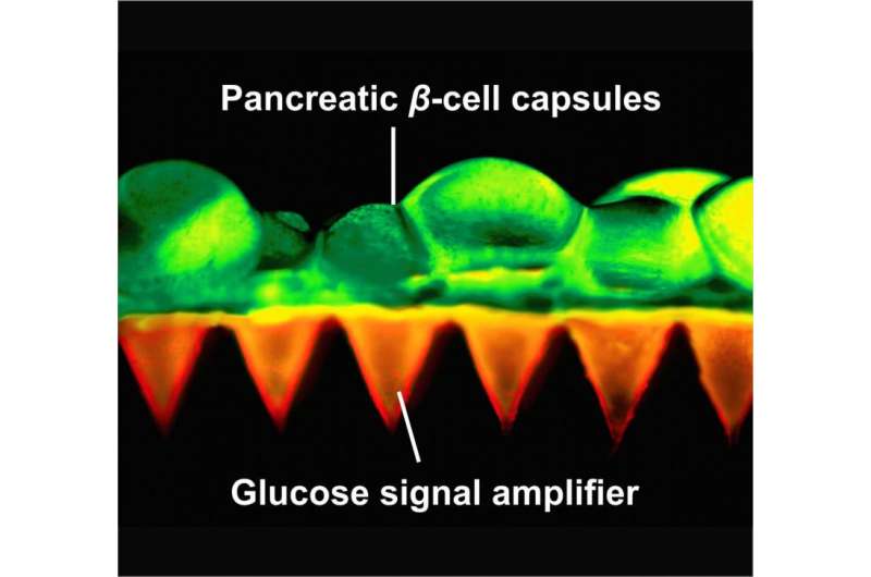 Scientists create painless patch of insulin-producing beta cells to control diabetes