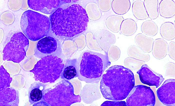 Scientists identify possible double whammy to attack leukaemia