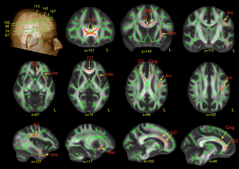 Study reveals subtle brain differences in men with autism