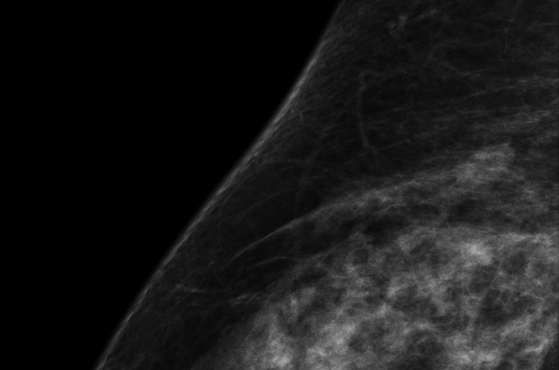 Artificial intelligence expedites breast cancer risk prediction