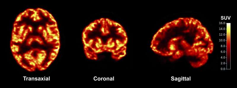 Scientists apply new imaging tool to common brain disorders