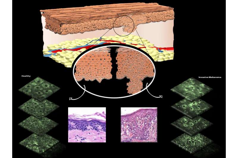 Noninvasive microscopy technique allows for spotting skin cancer in mitochondria