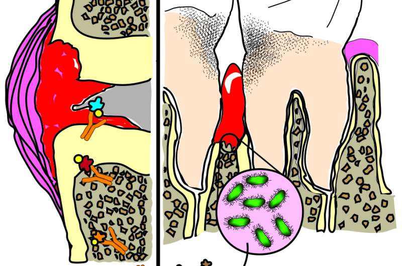 Researchers add to evidence that common bacterial cause of gum disease may drive rheumatoid arthritis