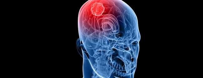 Study identifies new approach that could help prevent spread of deadly brain tumour