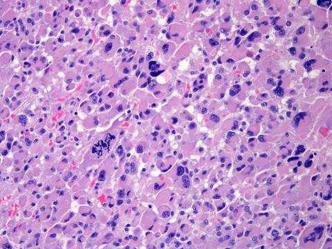 Scientists Identify New Drivers of Rare Cancer Type