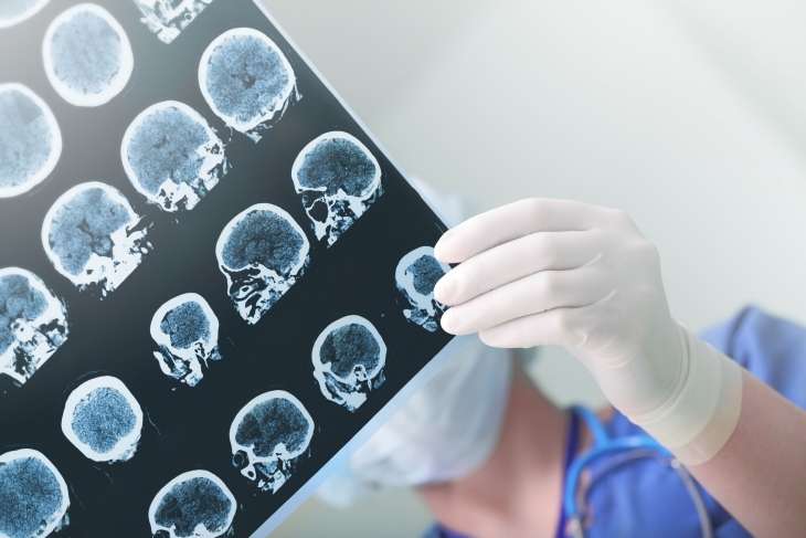 Researchers find key to stroke survival