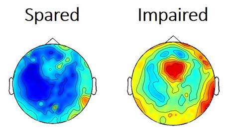 研究人员发现在缺乏癫痫发作期间普遍扰乱大脑活动