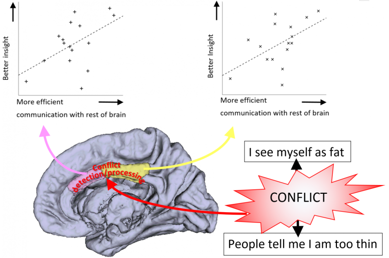 厌食症患者大脑“洞察力”区域的异常