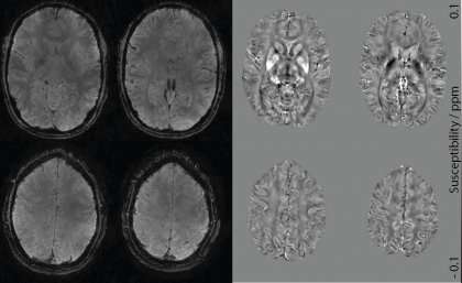 加速MRI脑定位技术提高神经退行性疾病诊断