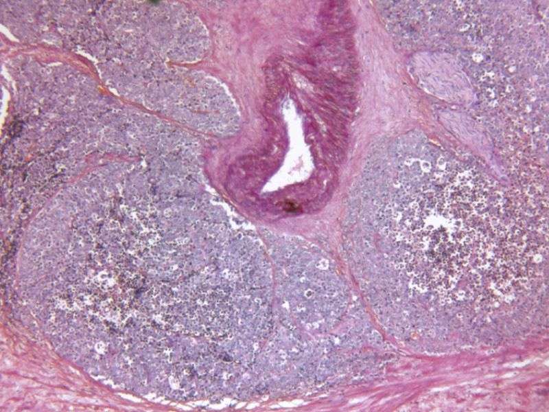 ADT +放疗ups在转移性前列腺癌生存CA