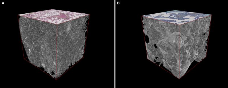 Advanced 3-D imaging technique applied for the first time to deadly lung disease