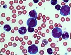 Aggressiveness of acute myeloid leukemia elucidated