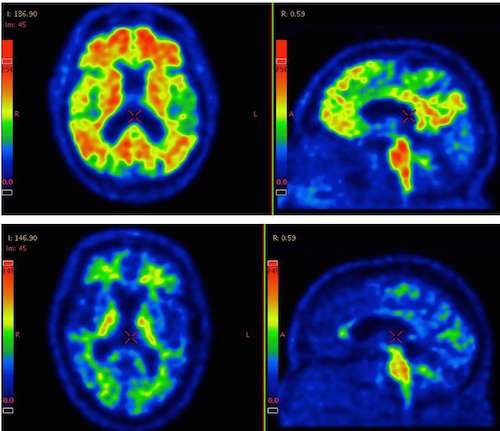 Alzheimer's more versatile than previously known