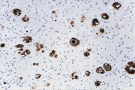Alzheimer-type brain pathology after transplantation of dura mater