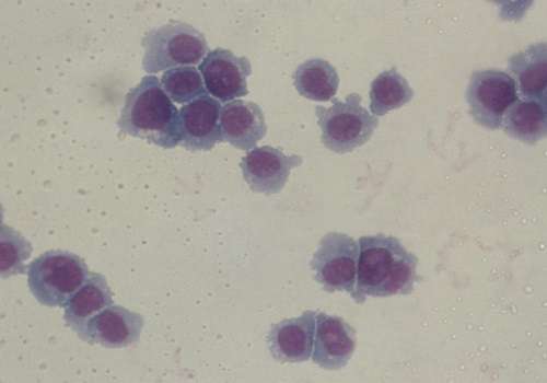 Antibodies directed against cancer stem cells could help patients with acute myeloid leukemia