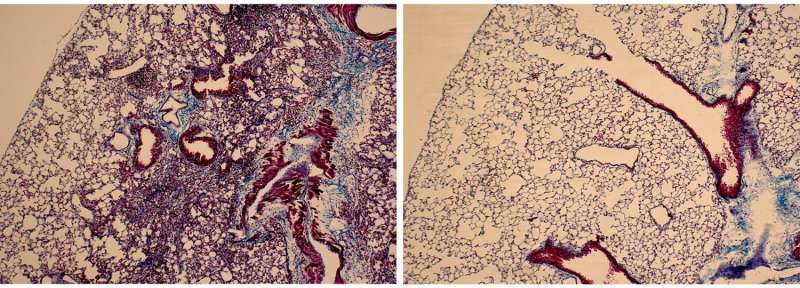 Anti-fibrotic peptide shows early promise against interstitial lung disease