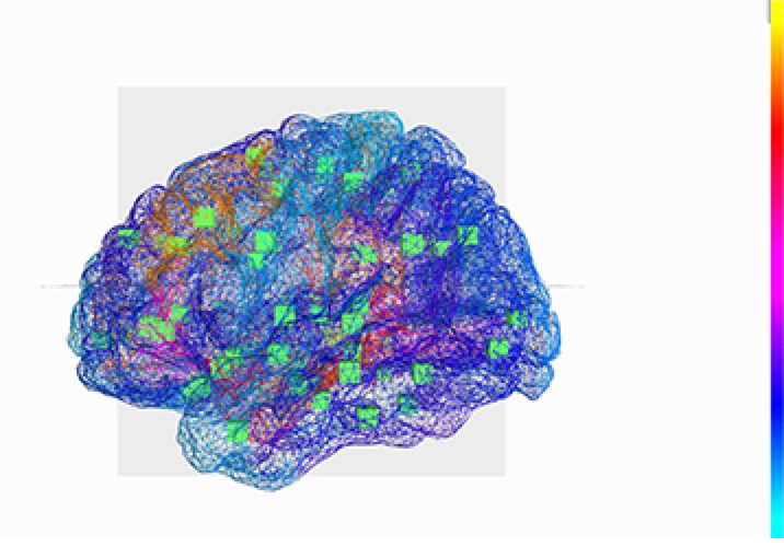 A virtual brain helps decrypt epilepsy