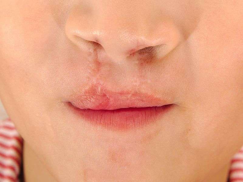 婴儿唇裂可能有正常的成年:研究