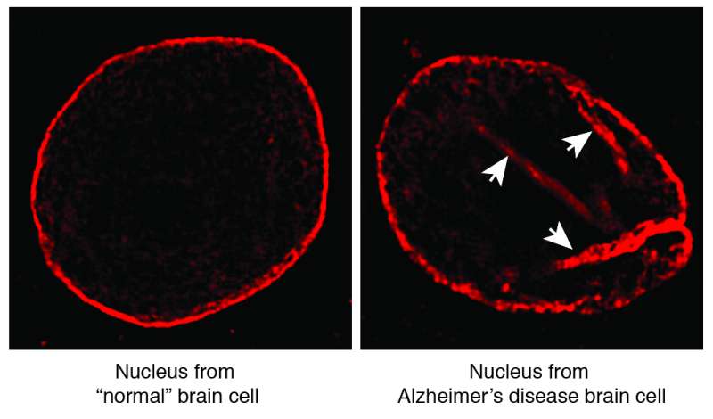Brain cell death in Alzheimer's linked to structural flaw