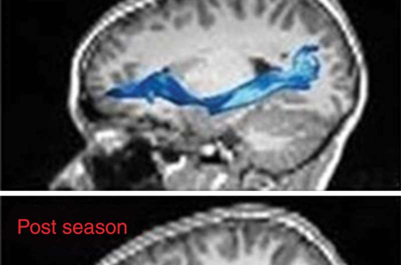 Brain changes seen in youth football players without concussion