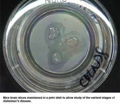 Brain in a dish to learn more about Alzheimer's disease