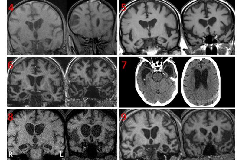 Brain scans of dementia patients with coprophagia showed neurodegeneration