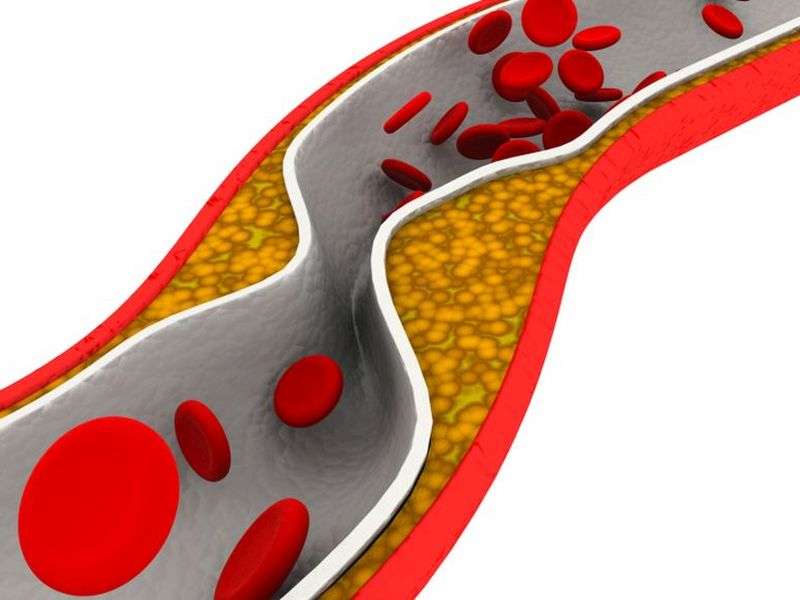 Cardiometabolic syndrome ups subclinical atherosclerosis risk