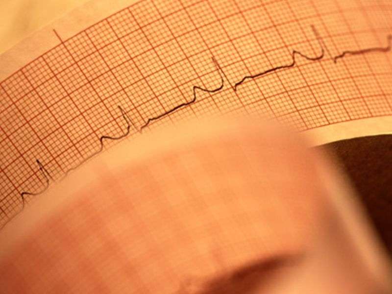 Cardiomyopathy etiology impacts catheter ablation outcomes
